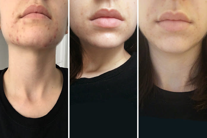 <p>The writer's skin before taking spironolactone, after two weeks taking the pill, and four weeks after taking it.</p>
 | <p>Courtesy photo. The writer's skin before, two weeks, and four weeks after starting spironolactone.</p>