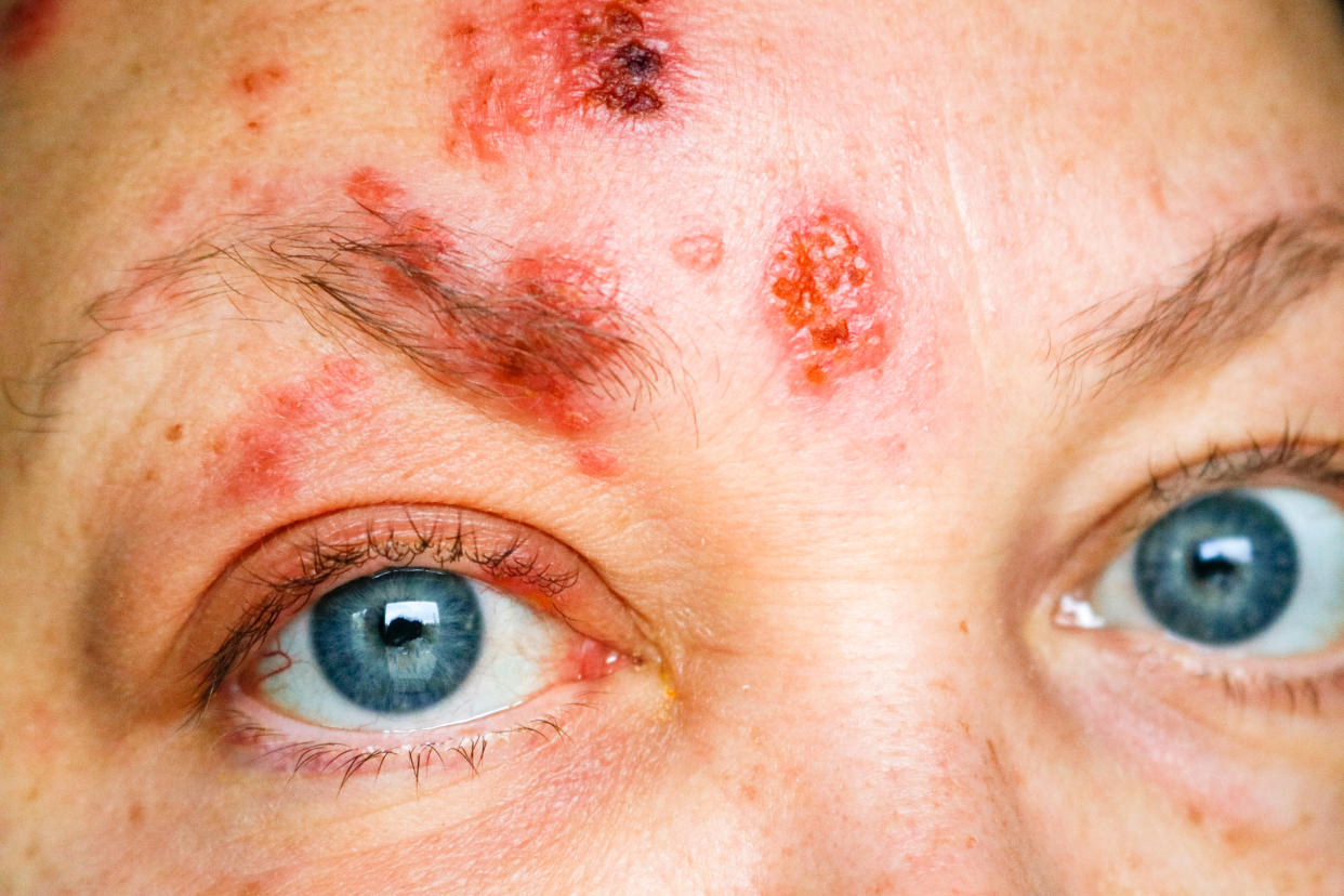 The shingles rash appearing on the face and around the eyes is called ophthalmic herpes zoster or herpes zoster ophthalmicus.