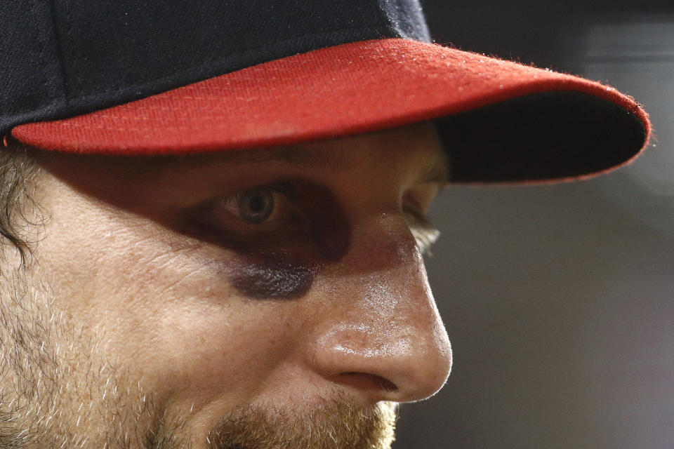 A bruise is visible below Washington Nationals starting pitcher Max Scherzer's right eye as he stands in the dugout in the seventh inning of the second baseball game of a doubleheader against the Philadelphia Phillies, Wednesday, June 19, 2019, in Washington. Scherzer broke his nose Tuesday while taking batting practice. (AP Photo/Patrick Semansky)