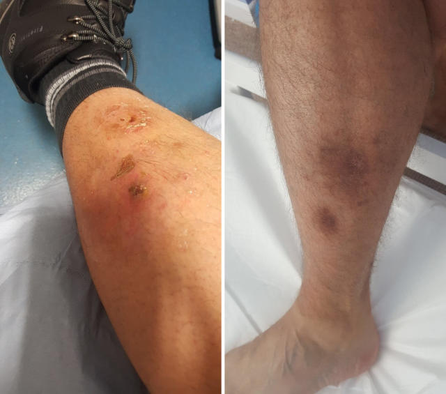 Man's Leg Ravaged By Flesh-Eating Spider Bite, UK News