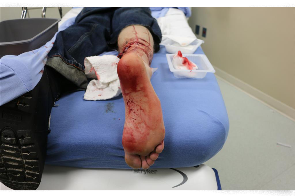 A hospital photo of the ankle injury after Hernando County deputies ordered their K9 to attack.