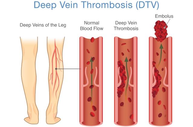 Compression Socks Can Dramatically Improve Your Sleep — But Only