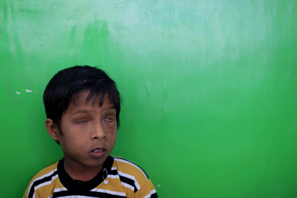 In this photo taken Tuesday, March 13, 2012, Deepak, 7, born mentally and physically disabled, a second generation victim of 1984 gas leak at the Union Carbide plant, waits to get his physiotherapy session at a clinic, in Bhopal clinic in Bhopal, India. The survivors of the tragedy of 27 years ago, with their lingering illnesses, sick children and dead relatives, faded away from the world's memory, even as their suffering went on. Now, though, they have seized on a new chance to force their plight in front of the world, the London Olympics. (AP Photo/Rafiq Maqbool)