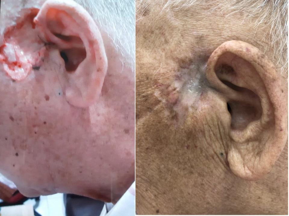 老翁左耳潰瘍系罹患皮膚鱗狀細胞癌，經同步進行化學治療與好神刀（放射治療）後，保留了耳朵外觀與聽力功能。（土城醫院提供）