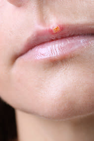 cold sore lesion