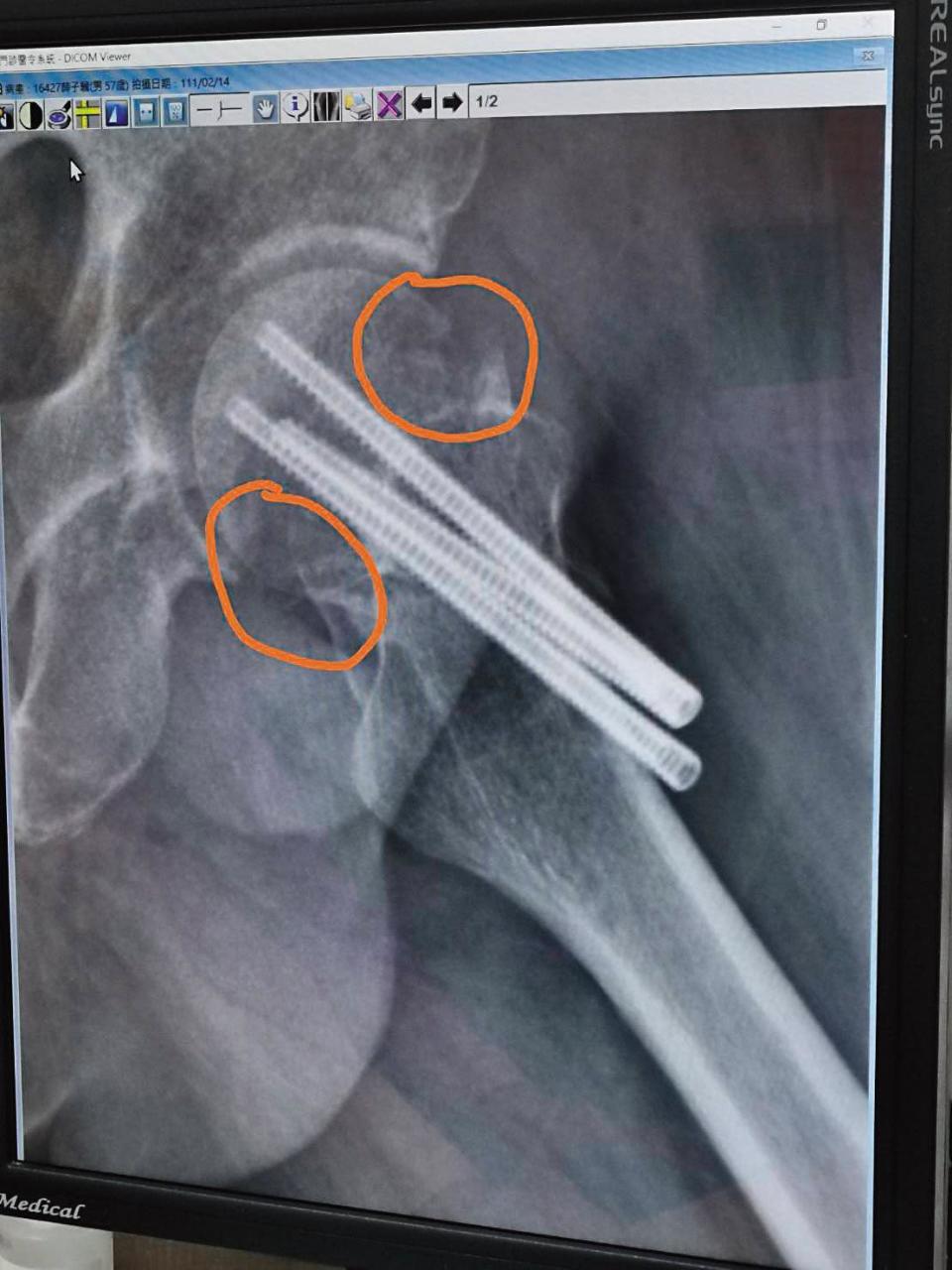薛志正去年因車禍左大腿股骨頸嚴重斷裂。（薛志正提供）