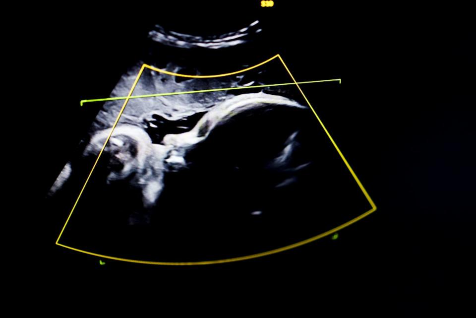 Ultrasound sonogram monitor of developing fetus