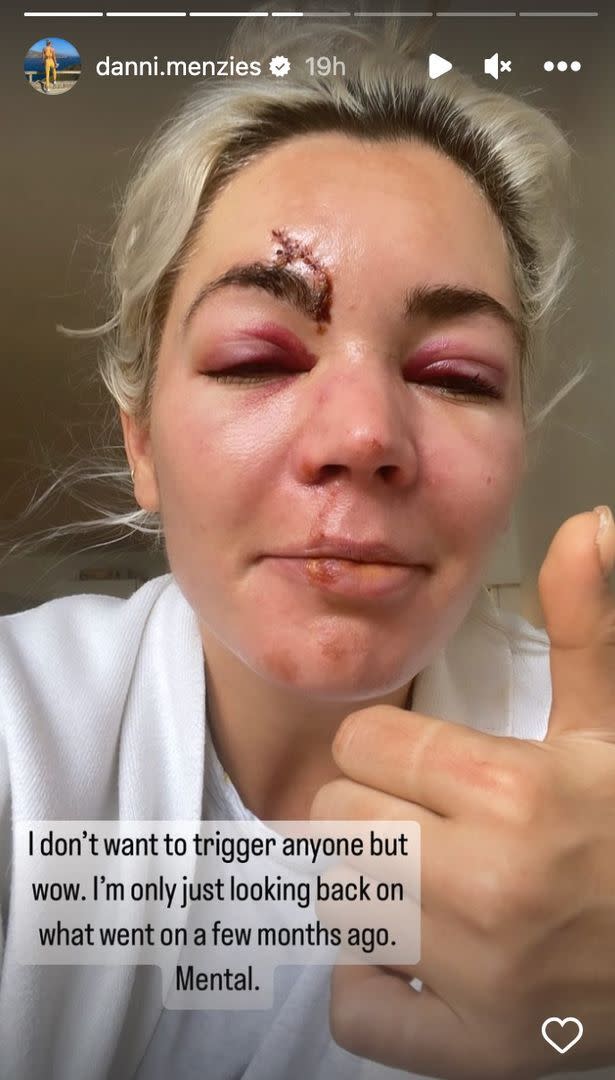 Danni Menzies shared a picture of her injuries. (Instagram)