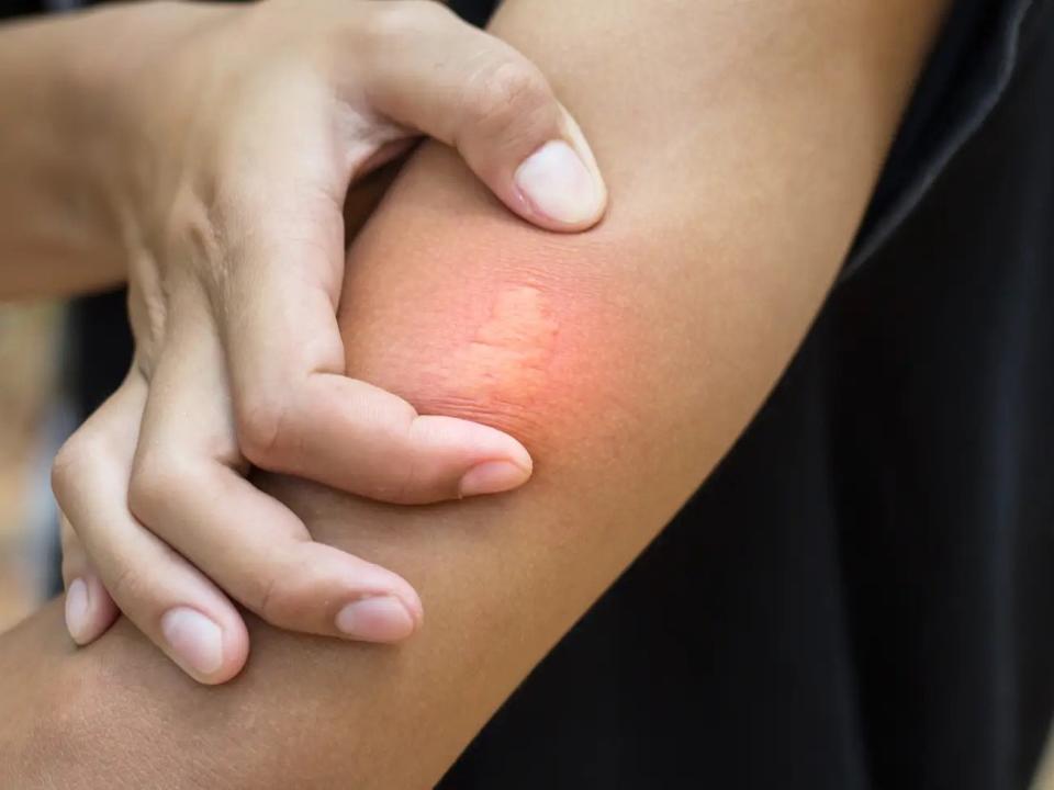 Wenn ihr von einer Wespe gestochen wurdet, treten in der Regel Schmerzen und Schwellungen in und um die Wunde auf. - Copyright: Wirachai / Getty Images