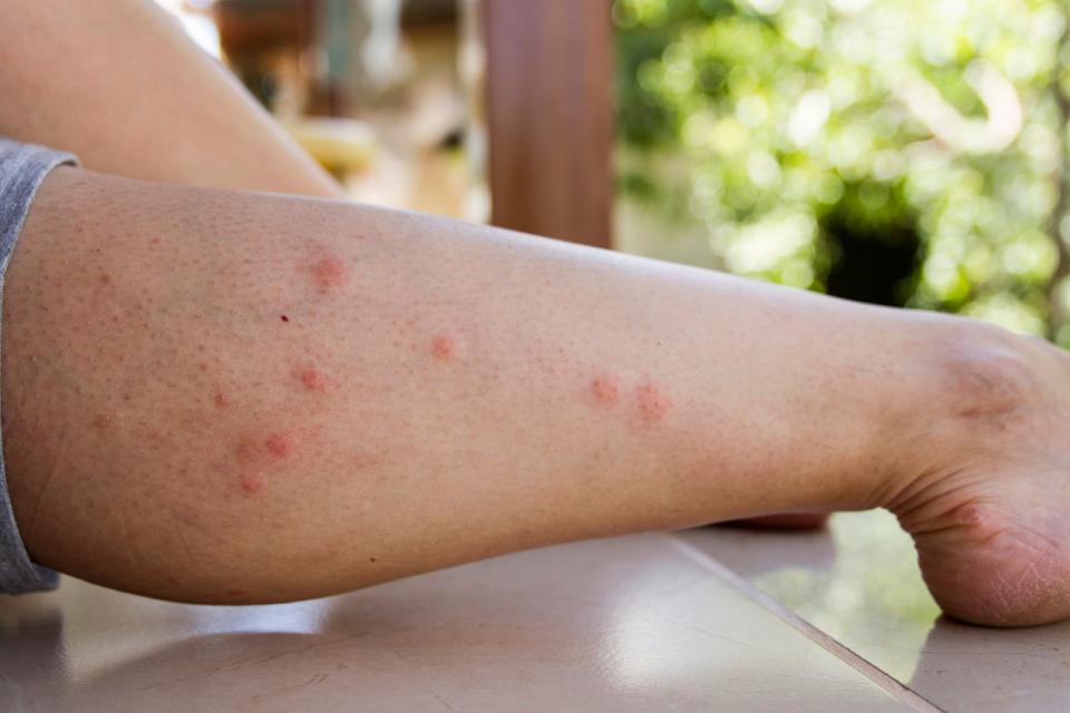 Mosquito bites on leg. 