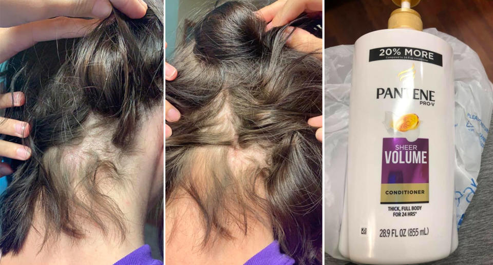 Ashley Robinson shows the areas of her hair affected by the hair removal cream. To the right of the image is the offending bottle of Pantene Pro V conditioner.