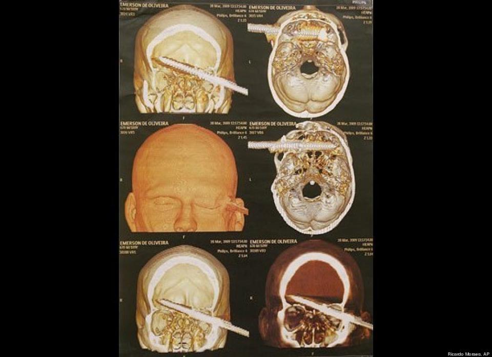 These CT scans show a 6-inch spear lodged in the head of Emerson de Oliveira Abreu, who sought treatment at a hospital in Brazil in late March. The spear pierced his head during an underwater fishing accident. After doctors operated to remove the spear, Abreau said he would never fish underwater again. 