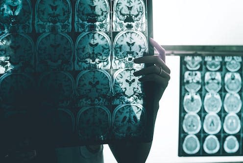 <span class="caption">Though this genetic form of Alzheimer's only affects around 1% of the population, it provides useful information on how the disease progresses.</span> <span class="attribution"><a class="link " href="https://www.shutterstock.com/image-photo/alzheimers-disease-on-mri-677114992" rel="nofollow noopener" target="_blank" data-ylk="slk:Atthapon Raksthaput/ Shutterstock;elm:context_link;itc:0;sec:content-canvas">Atthapon Raksthaput/ Shutterstock</a></span>