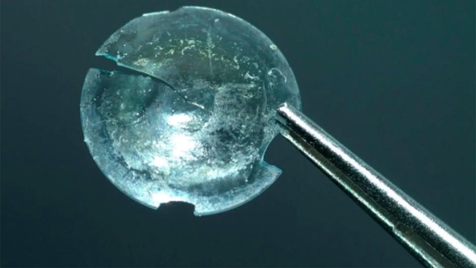 Doctors removed a cyst and found a hardened contact lens inside. Source: BMJ Case Reports