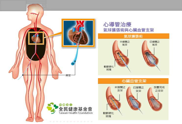 心導管