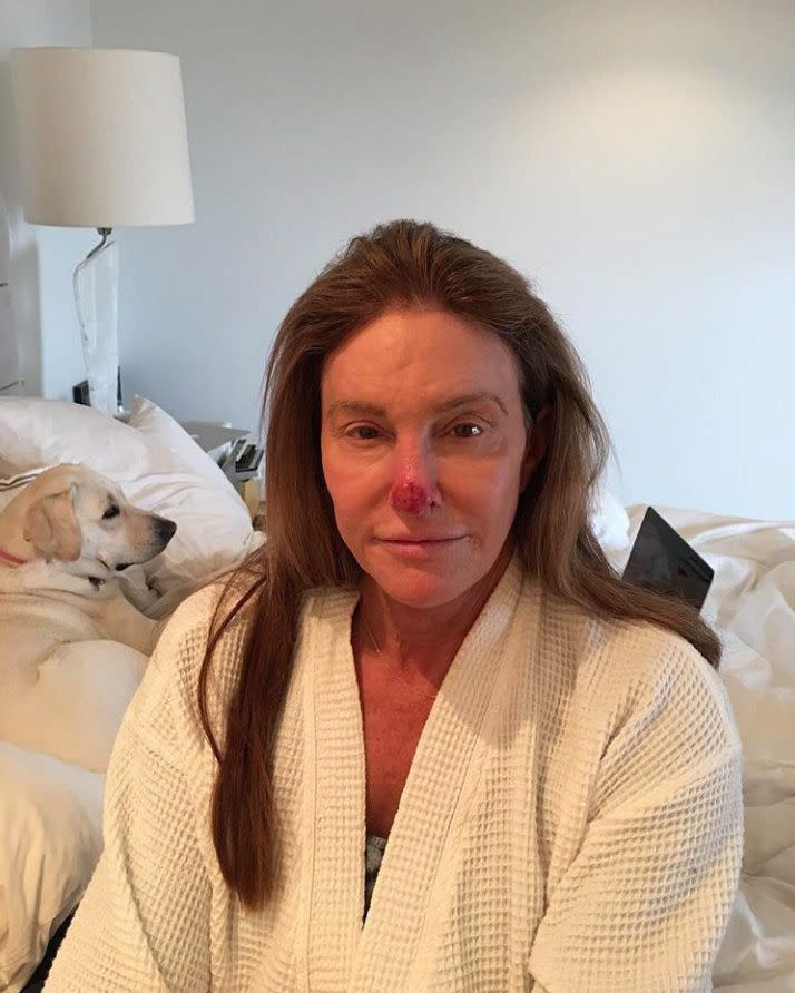 Caitlyn Jenner revealed the nasty aftermath of unsafe sun practice. The 68-year-old shared a photo of herself after she had sun damage removed from her nose. Jenner shared the photo to Instagram on March 20, 2018, along with the caption, "I recently had to get some sun damage removed from my nose. PSA- always wear your sunblock!" According to PEOPLE, she had a cancerous basal cell carcinoma removed from her nose.