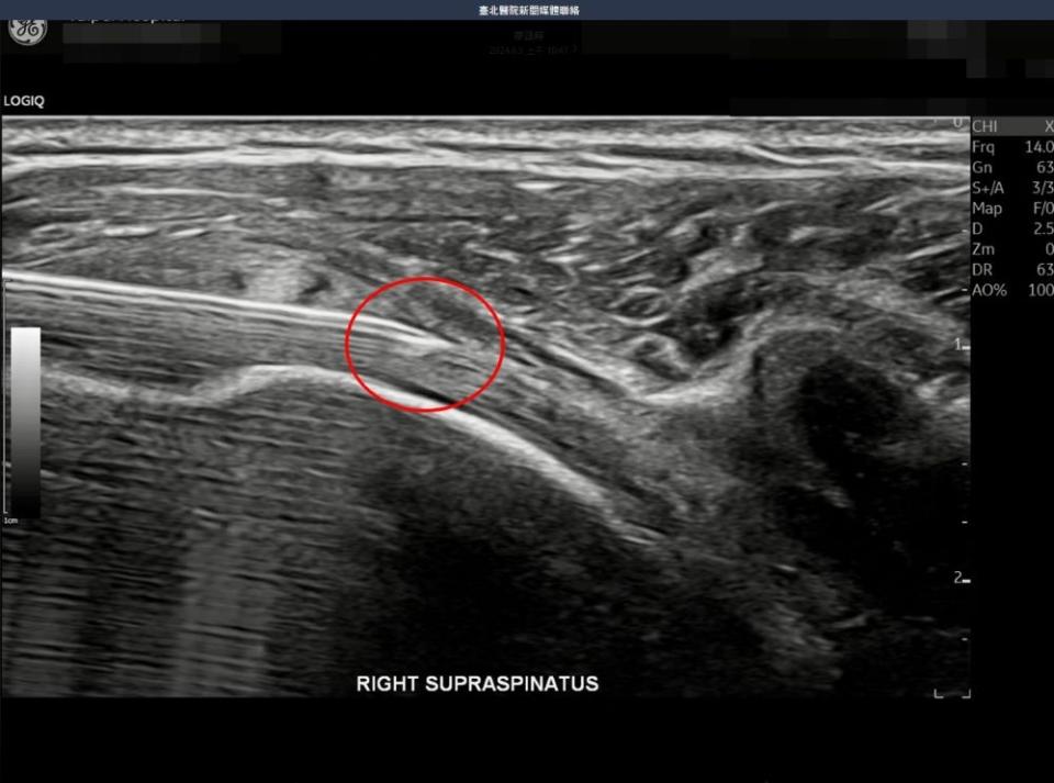 《圖說》藉由醫師精準超音波導引注射手法，針尖清晰可見，使PRP生長因子到達受傷的肌腱，針到藥達。〈臺北醫院提供〉