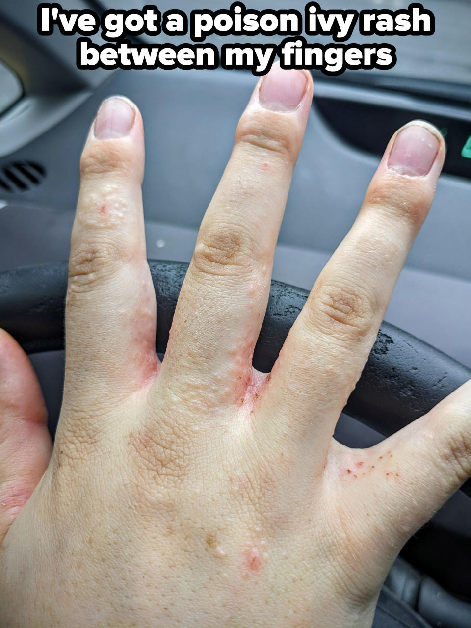 Close-up of a poison ivy rash between someone's fingers