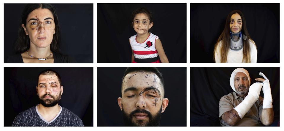 This combo of photos taken between Aug. 13 and Aug. 16, 2020, shows people who got injured during the Aug. 4 explosion that killed more than 170 people, injured thousands and caused widespread destruction, pose for a photograph in Beirut, Lebanon. (AP Photo/Hassan Ammar)