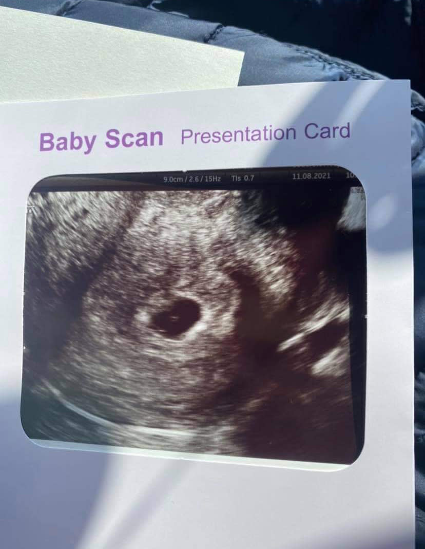 Faye and Ben Orton's baby scan. The couple are sharing the story of their miscarriage for Baby Loss Awareness Week. (Supplied)