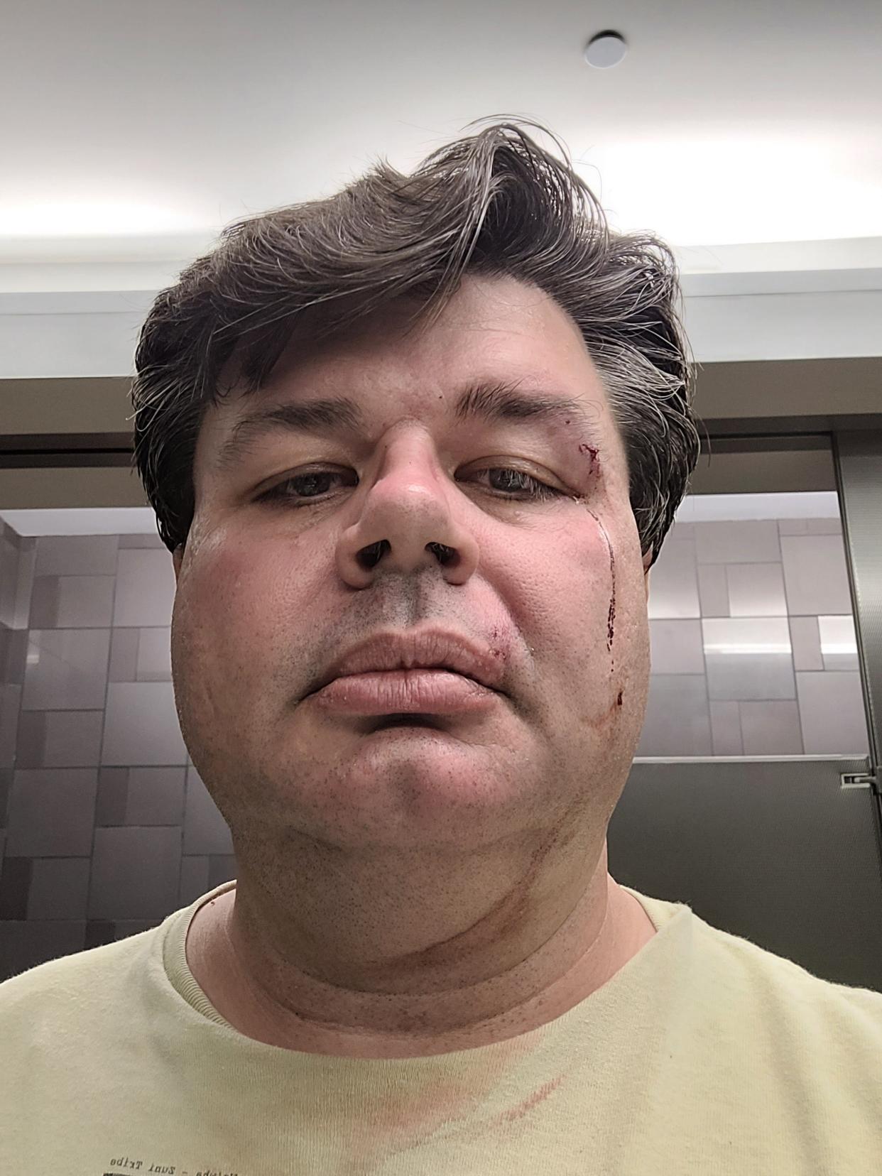 David Boyles, an instructor at Arizona State University, posted a photo of his injuries on Instagram after two unknown people confronted him on Oct. 11, 2023, in a campus parking garage.