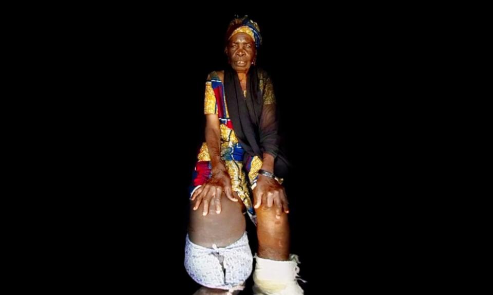 A woman with severe elephantiasis,&nbsp;a disease that&nbsp;-- if left untreated -- can cause irreversible swelling of the limbs. (Photo: HuffPost)