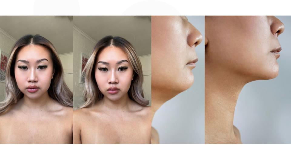 Before and after facial sculpting images