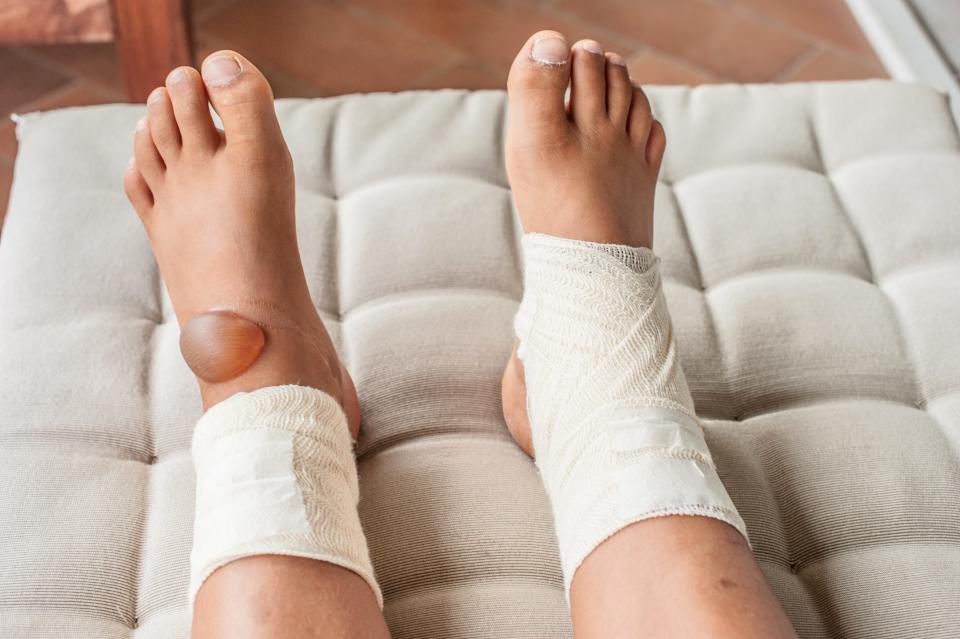 Picture of a person's feet, the left foot has a large blister caused by a second degree burn. Both ankles and feet are wrapped in gauze. 