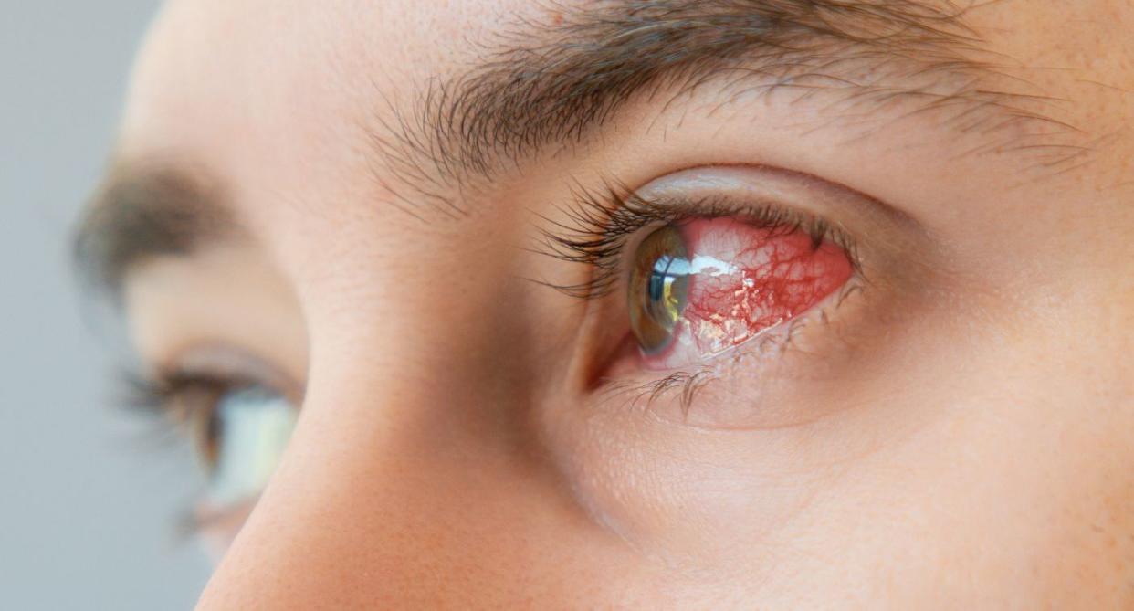 Syphilis - male's eyes with bloodshot symptoms. (Getty Images)