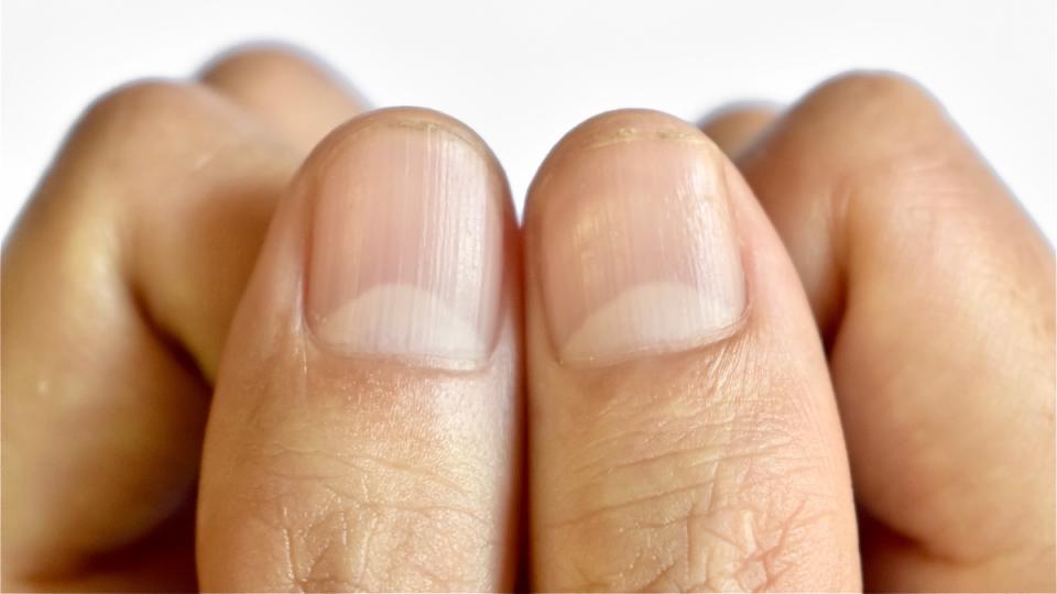 An image of two thumbs which do not have nail dents