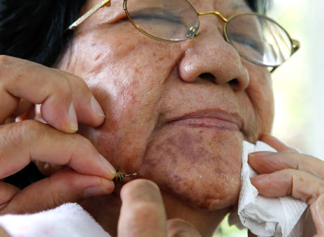 A woman with allergies is stung with a bee by a bee sting therapist in a farm in Silang, Cavite south of Manila.Farm owner Joel Magsaysay uses bee stings to treat patients with ailments such as hypothyroidism, paralysis and cancer. Magsaysay said the bee's venom contains a potent cocktail of proteins that boost auto-immune system that let the body activate the nerves and heal itself. REUTERS/Erik De Castro