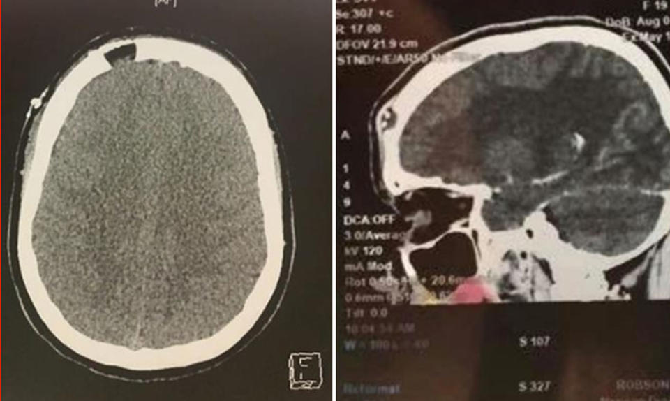 Scans show a hole in the skull of Jorgia Robson's head caused by Langerhans Cell Histiocytosis. She thought the cell growth was a pimple.