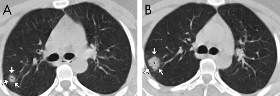 COVID 19 chest scan 