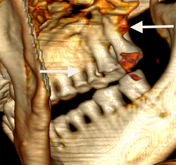 The Iceman: Lost in the Italian Alps 5,000 Years Ago