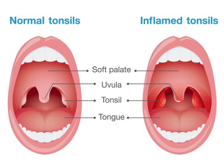  <span class="attribution"><a class="link " href="https://www.shutterstock.com/editor/image/comparison-between-normal-tonsils-inflamed-this-417077221" rel="nofollow noopener" target="_blank" data-ylk="slk:solar22/Shutterstock;elm:context_link;itc:0;sec:content-canvas">solar22/Shutterstock</a></span>