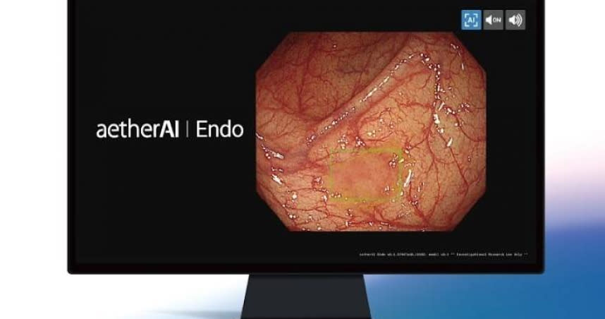 臺大醫院、國泰醫院與雲象科技合作的「大腸鏡即時AI瘜肉偵測 aetherAI Endo」獲得衛福部TFDA醫材許可，加入打擊大腸癌防治工作。（圖／國泰醫院提供）