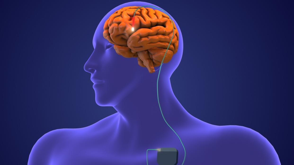  Illustration showing an electrode implanted in the center of a person's brain with a wire extending out of. 