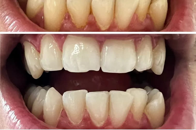 One customer before and after using My Sweet Smile teeth whitening powder