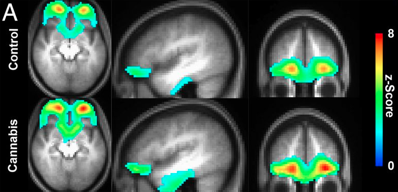 marijuana mri brain scan weed 