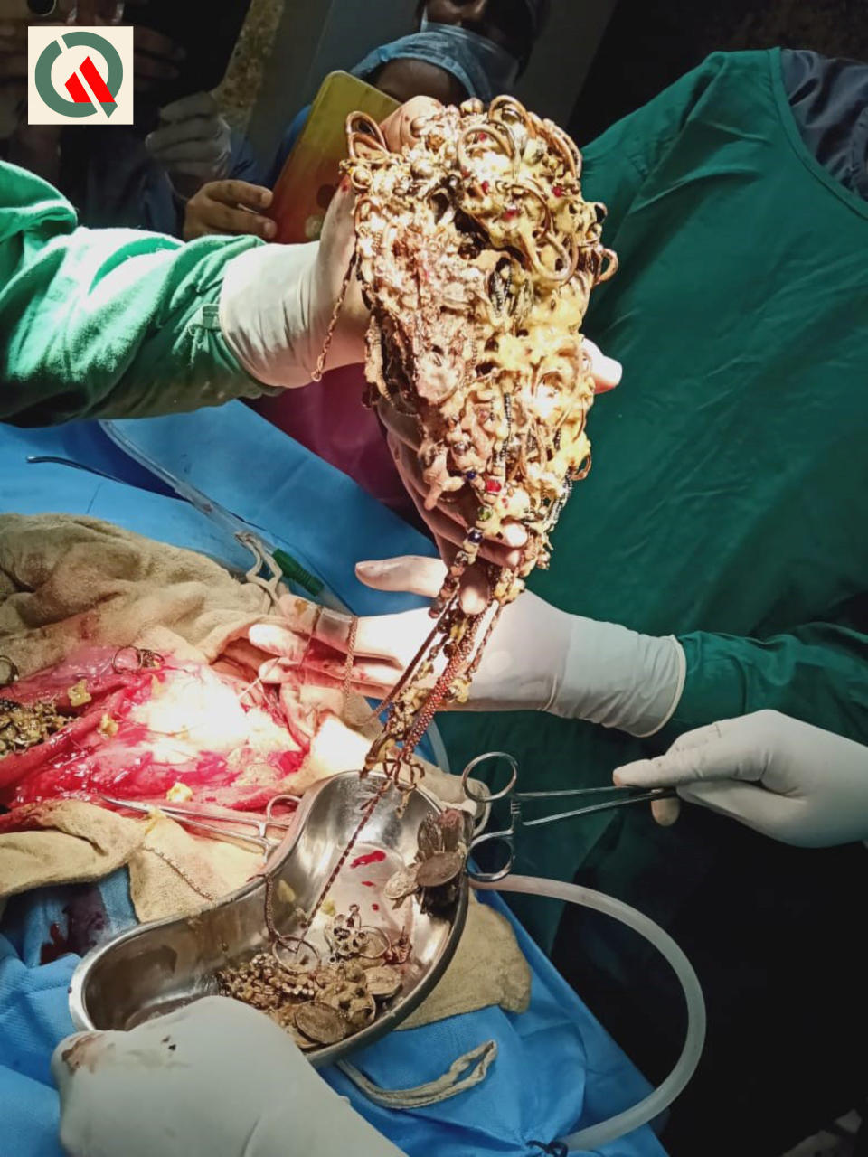 A doctor holds a mass of chains, nose rings and other metal objects in his hand. 