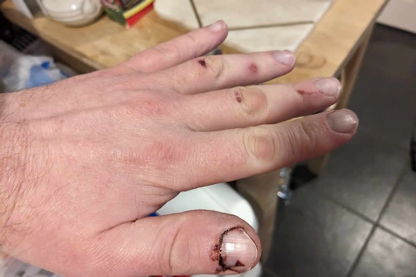 Both of Gary's hands were bitten by the dogs