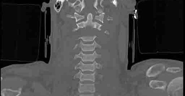 An X-Ray shows Tony's severed spine. Source:NJCMedia