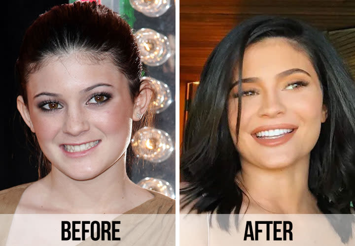 21 Celebrity Dental Implants And Veneers Before And After