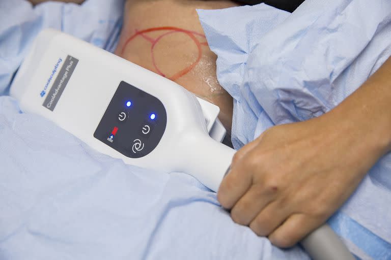 El CoolSculpting es una de las alternativas más populares para eliminar la grasa indeseada