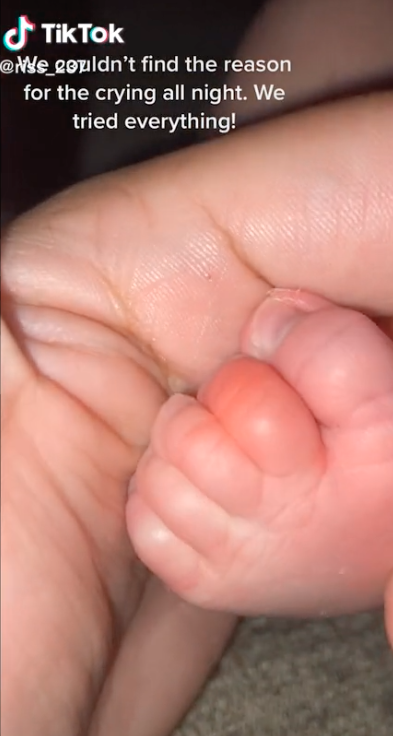 Baby's toe red and swollen after hair 