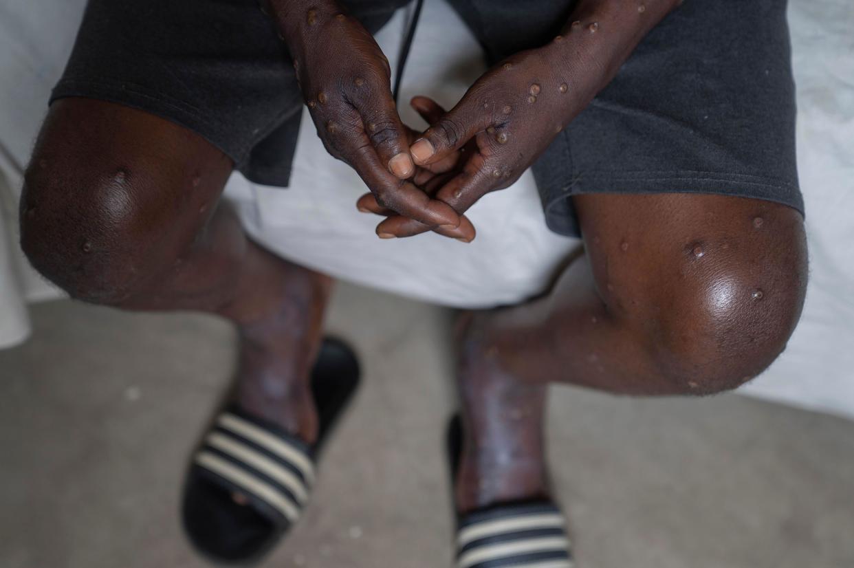 A man with mpox in the Democratic Republic of the Congo. (AP)