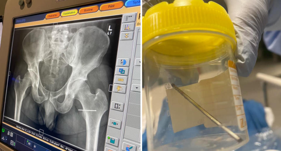 Left, X-ray shows the nail lodged inside his bum. Right, the nail is inside a clear tube after successfully removed. 