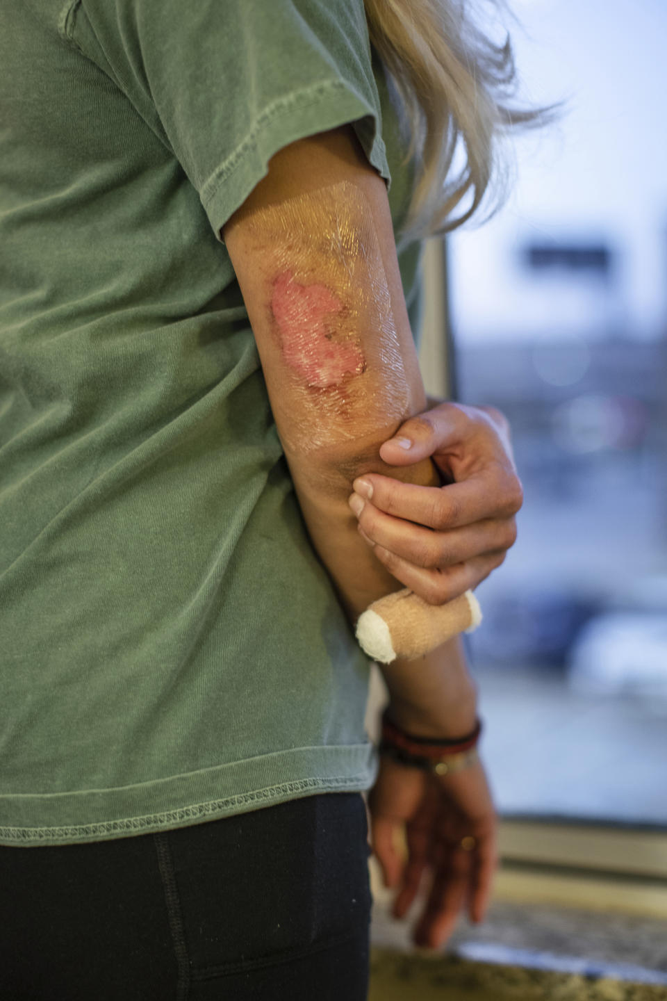 Jackie Nguyen's arm shows wounds Sunday, Feb. 21, 2021, on Houston from a house fire in which she was injured and her three children were killed during the winter freeze Tuesday in Sugar Land, Texas. The children's grandmother Loan Le also died. (Marie D. De Jesús/Houston Chronicle via AP)