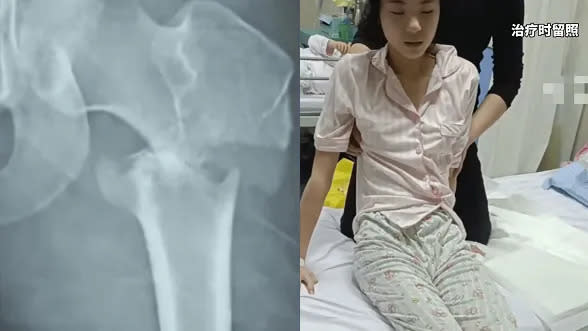 美少女張同學的X光照片，醫生表示她已經不能再跳舞了。翻攝微博/四川遠倫教育舞蹈培訓機構事件
