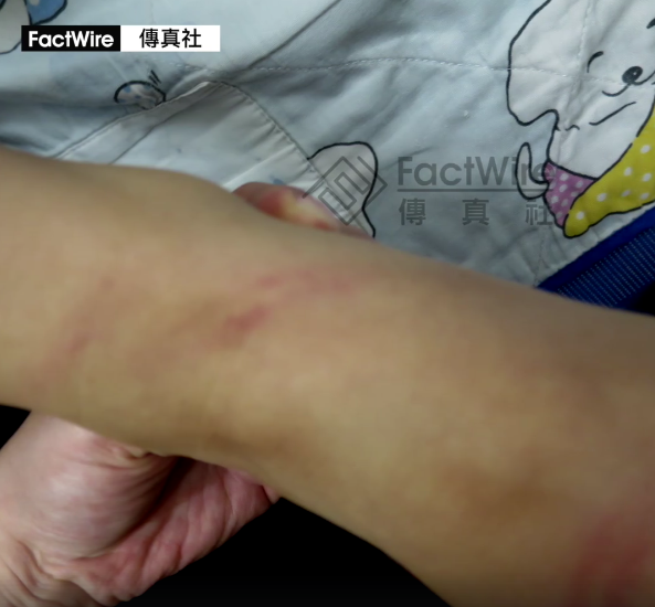 5歲臨臨死前4個月照片曝光  手腳及面部佈滿瘀痕